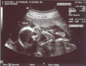 female fetus 20 weeks